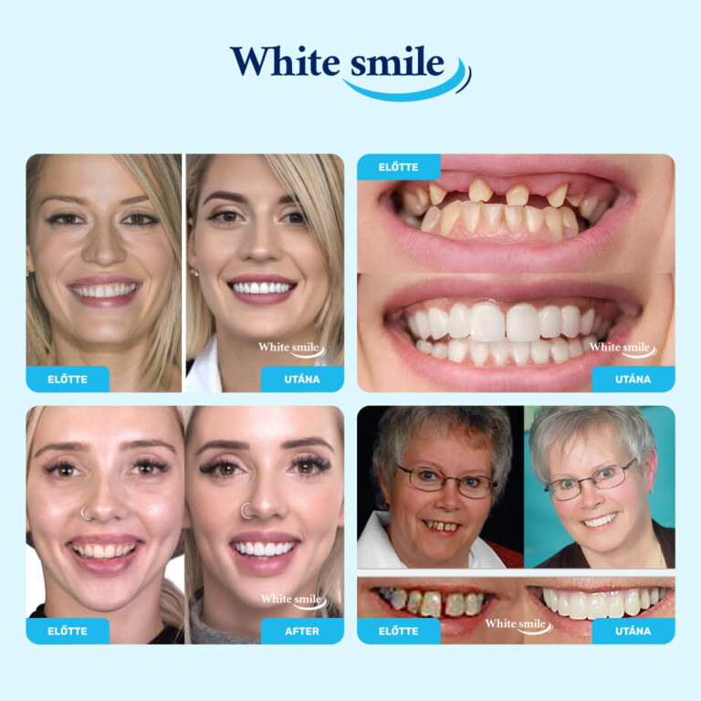 Valósághű műfogak: WhiteSmile 1+2 INGYEN - Image 2